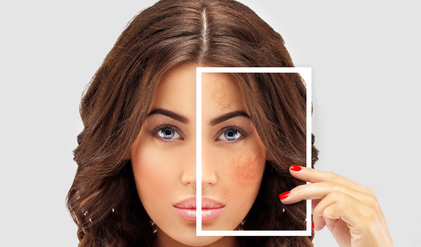 Hyperpigmentation – Dark patches that obstruct your beauty